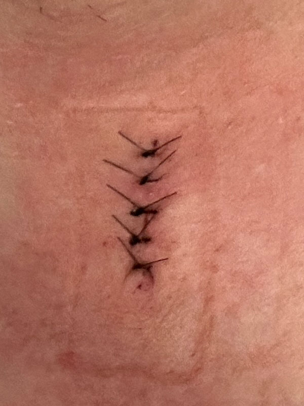 Mole removal after image